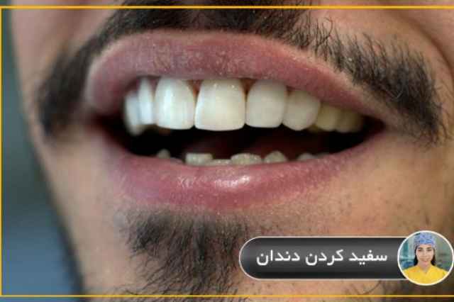 قيمت سفيد كردن دندان در تهران