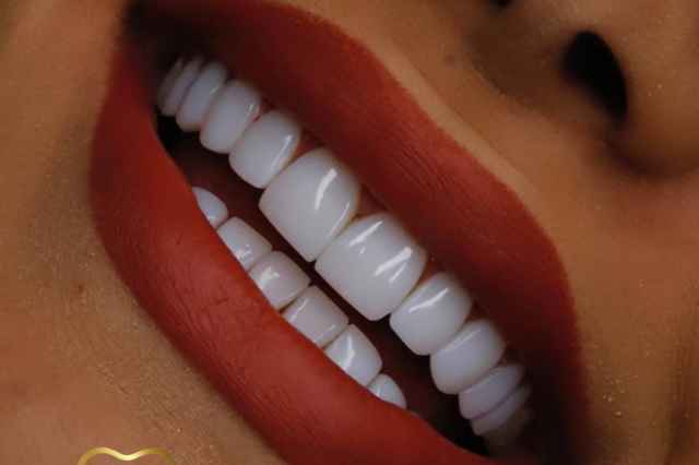 كامپوزيت دندان-تخفيف 15تا30درصدي-كلينيك آرت دنتال