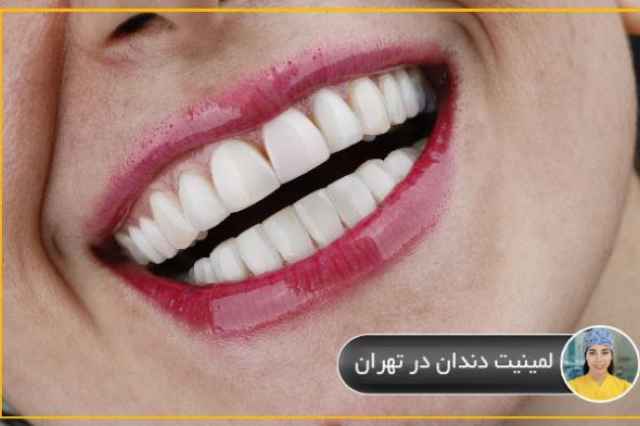 لمينيت دندان در تهران